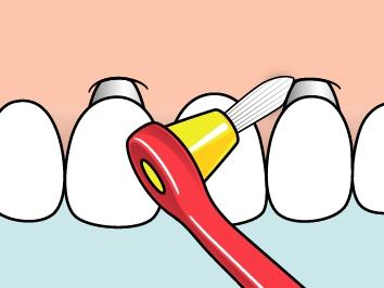 TePe Interspace™ Medium (includes 12 refills)